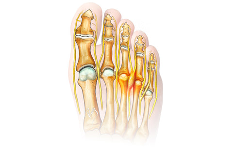 Douleurs aux pieds du cycliste — illustration 1