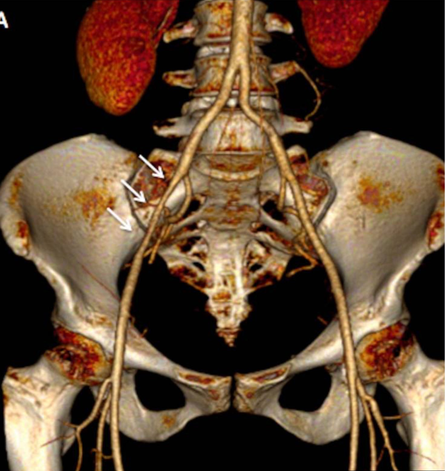 L'endofibrose iliaque externe, qu'est ce que c'est ? Et comment la prévenir ?